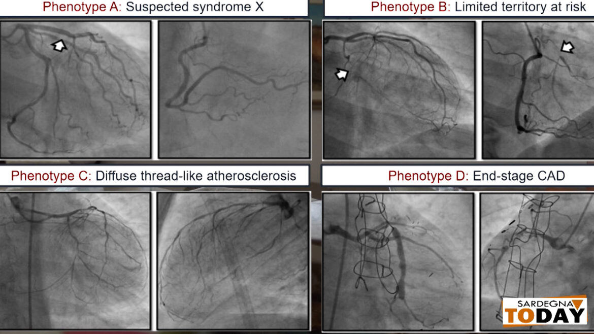 All’Ospedale Sirai di Carbonia nuova tecnica per la cura dell’angina refrattaria